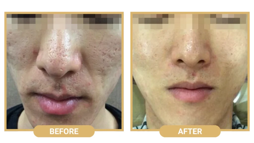 A Rejuran patient's before and after photo of their facial rejuvenation treatment.