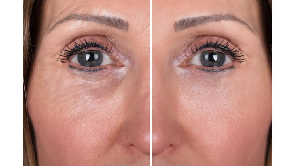 A patient's before and after photo of their under eyer rejuvenation treatment.