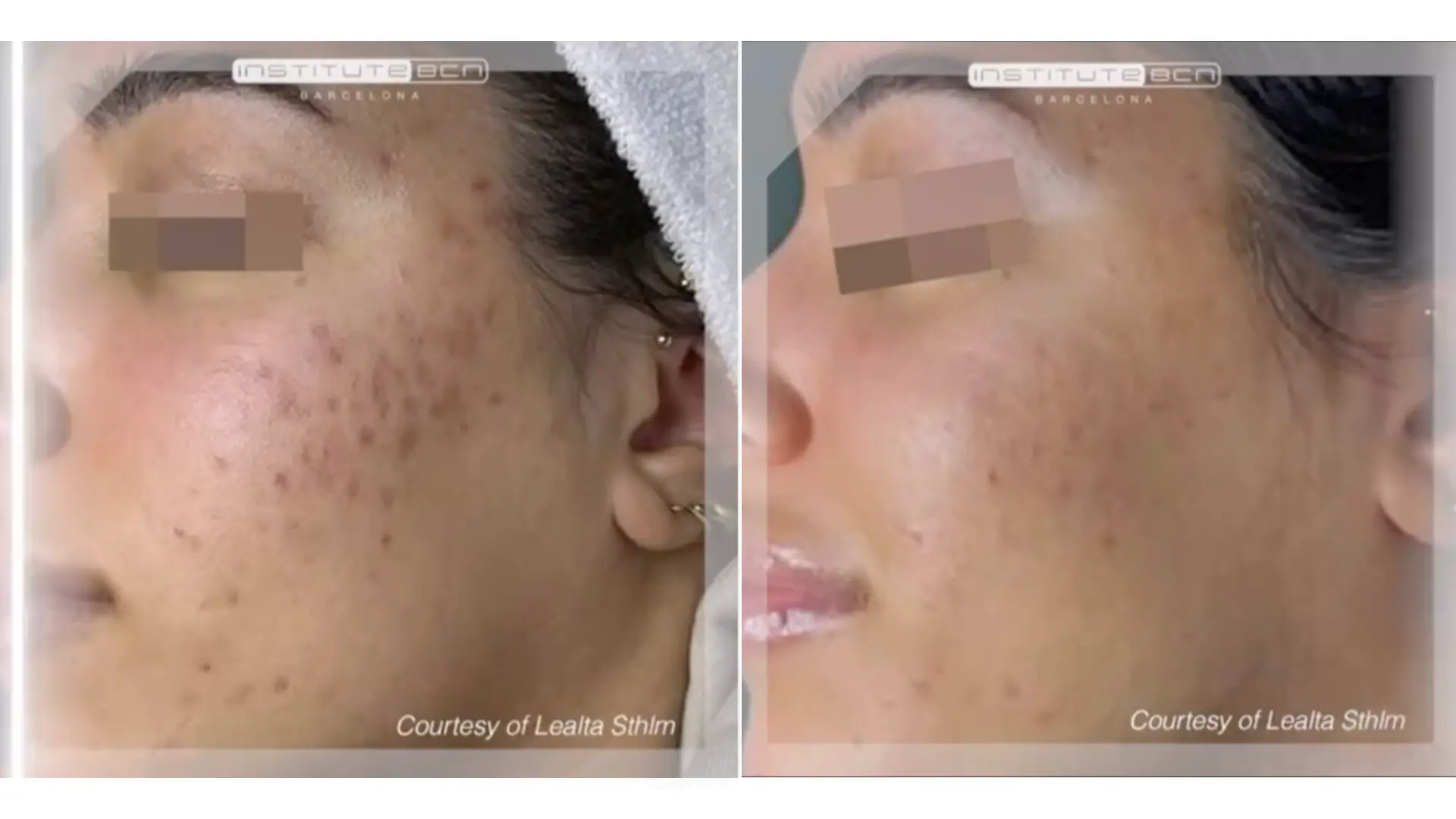 A patient's before and after photo of their Institute BCN Melano's treatment for their cheeks,.