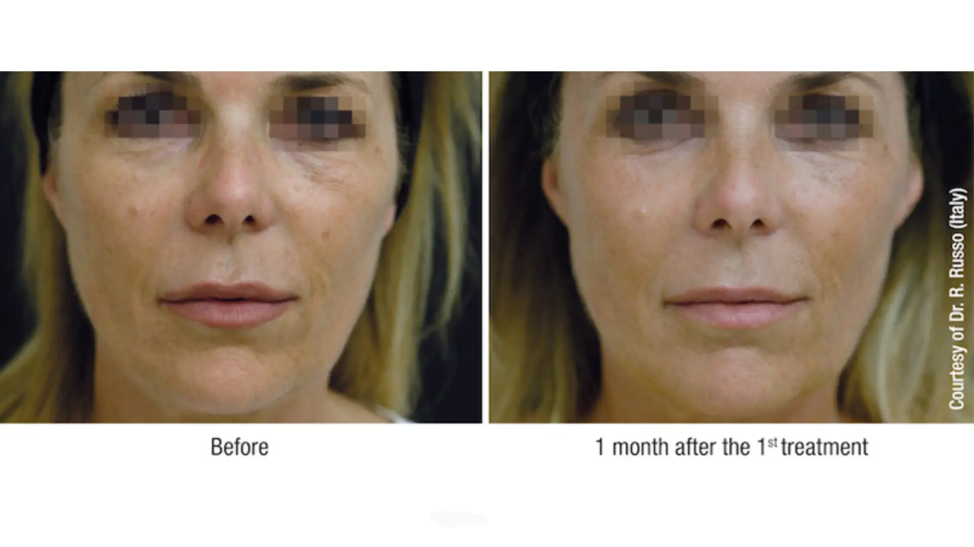 A patient's improved skin hydration and skin texture after their Viscoderm treatment.
