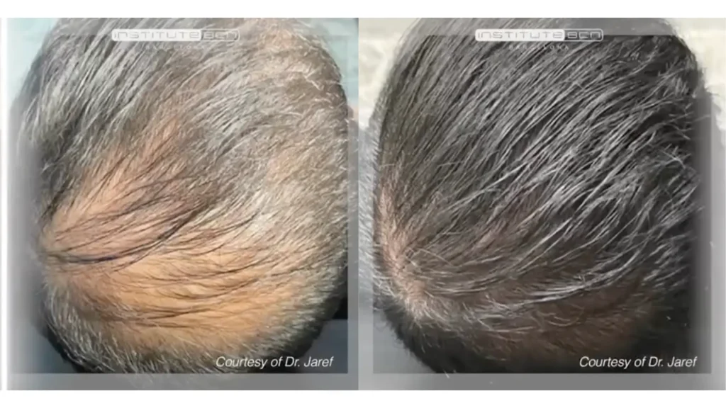 A patient's before and after photo of their BCN hair mesotherapy treatment.