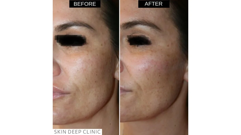 A patient's before and after photo of their midface enhancement with Aliaxin.