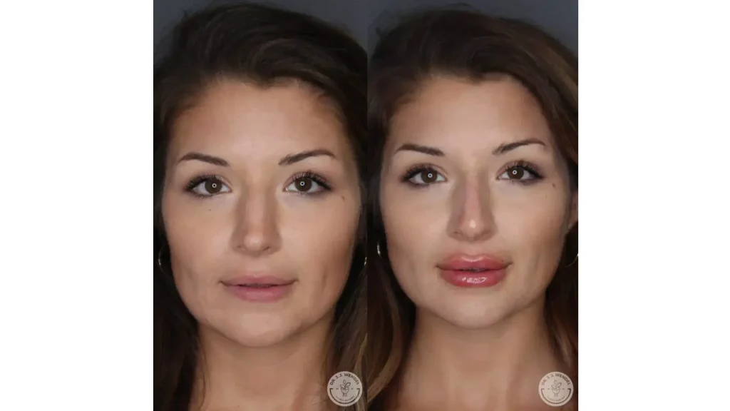 A patient's before and after photo of their Juvederm Volbella injectable lip treatment.