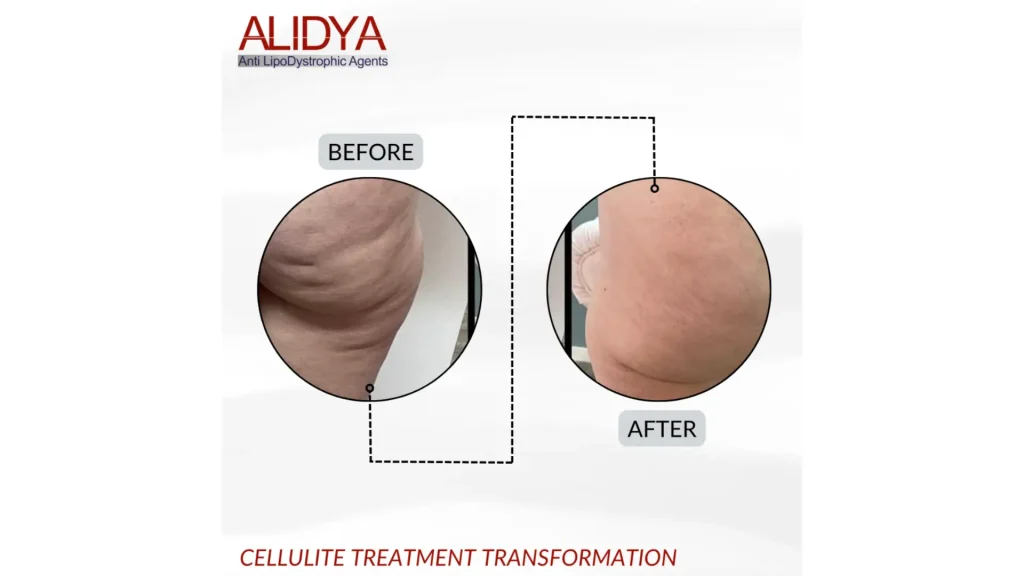 An Alidya-treated patient's before and after photo of their cellulite treatment in their buttocks region.