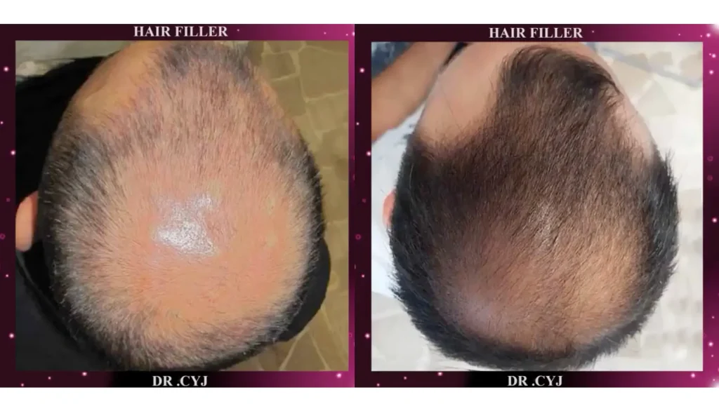 A patient's before and after photo of their Dr. CYJ Hair Filler treatment.