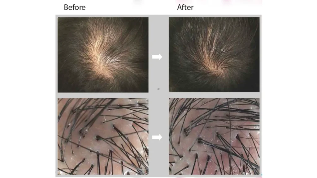 A patient's before and after photo of their treatment of Dr CYJ for hair thinning.