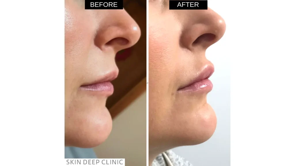 A patient's before and after photo of their lip treatment with Aliaxin.