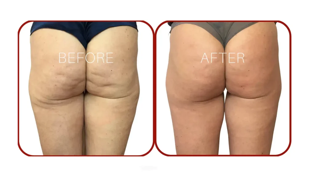 A patient's before and after photo of their buttocks' cellulite treatment with Alidya.
