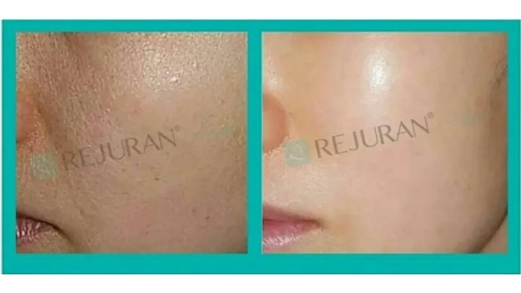 A close-up shot of a patient's before and after photo of their cheek region.