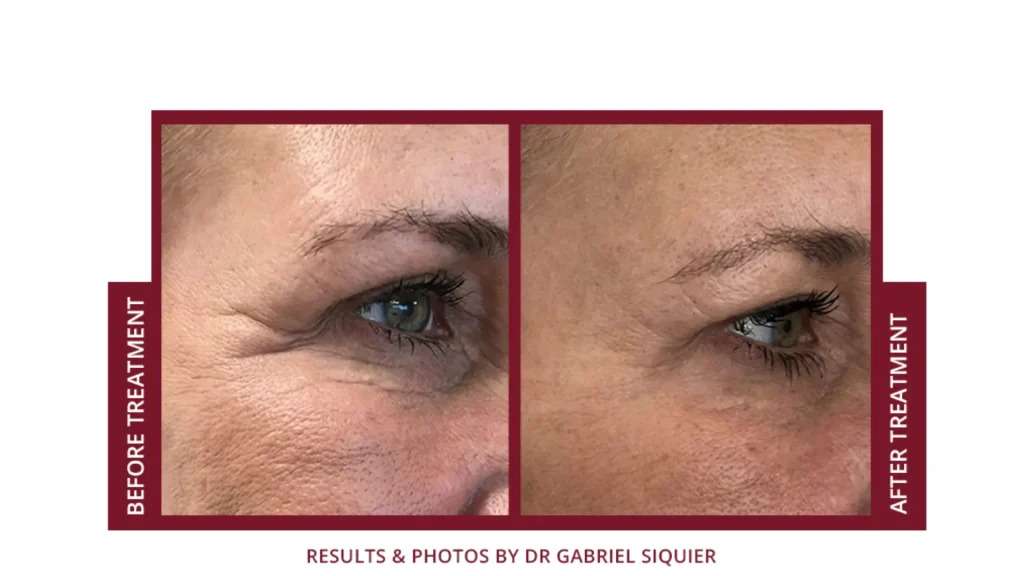 A patient's before and after treatment of the eye and under eye region.