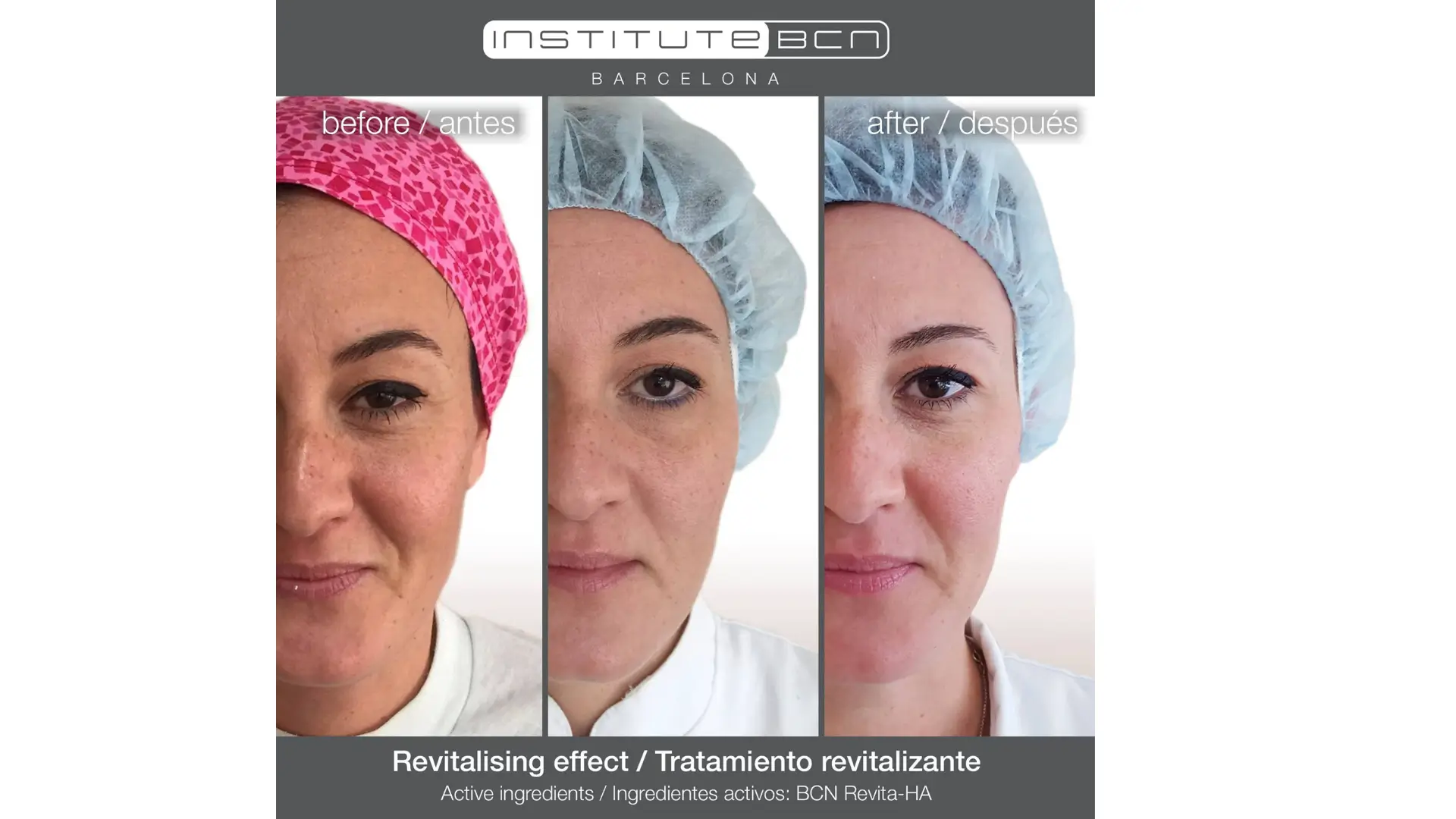 A patient's before and after photo of their BCN Revita-HA treatment for their facial region.