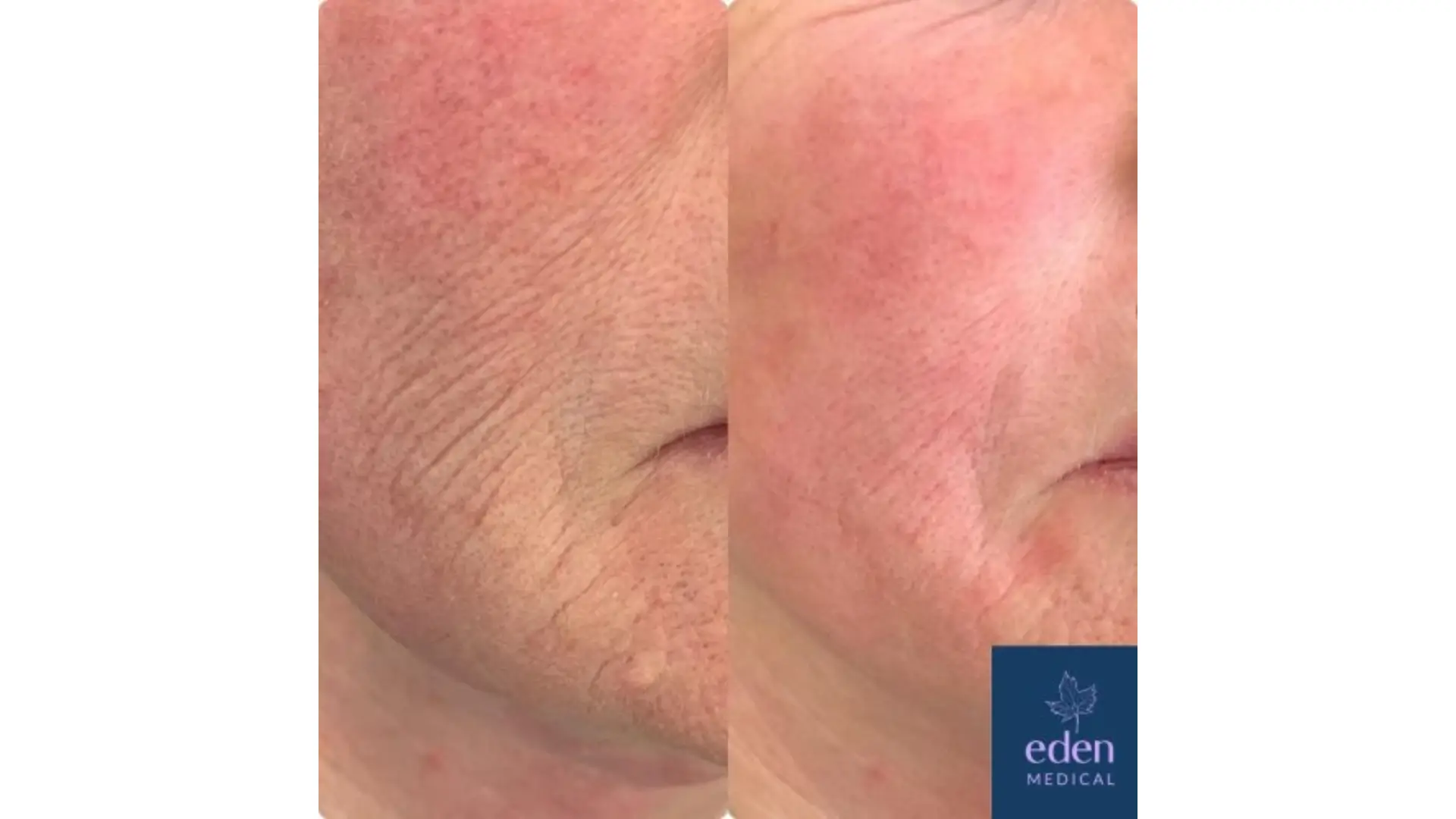 A patient's before and after photo of their improved skin elasticity after Viscoderm treatment.