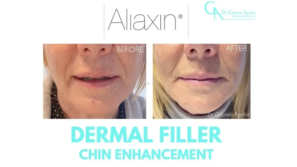 A patient's before and after photo of their chin enhancement with Aliaxin.