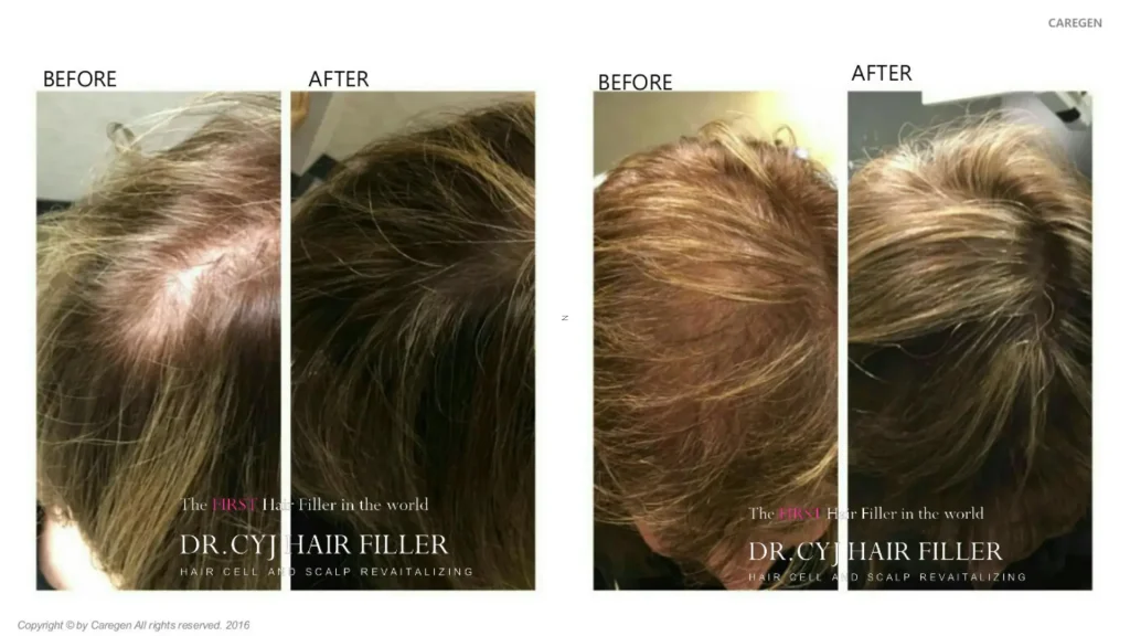 A patient's before and after photo of their Dr CYJ Hair Filler treatment for their hair loss.