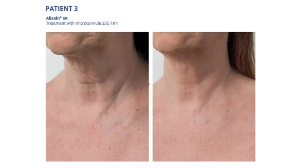 A patient's before and after photo of their neck treatment with Aliaxin SR.