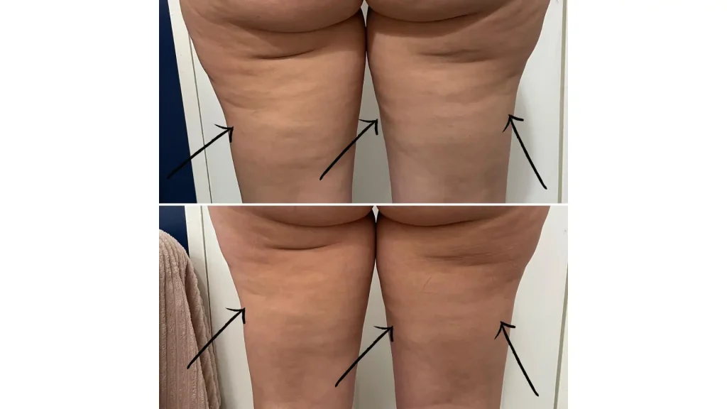 A patient's before and after photo of their Alidya treatment at the back of their thighs.