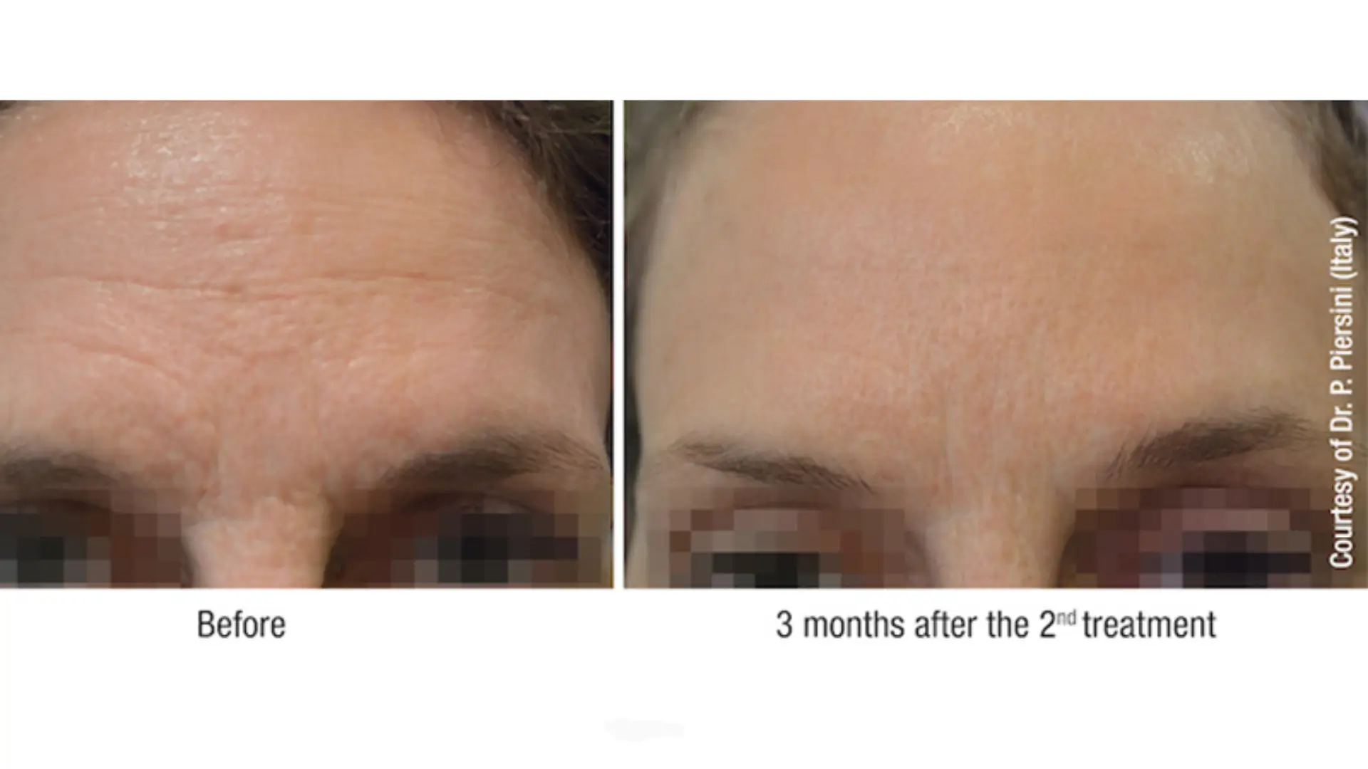 A patient's improved forehead appearance with their Viscoderm before and after photos.