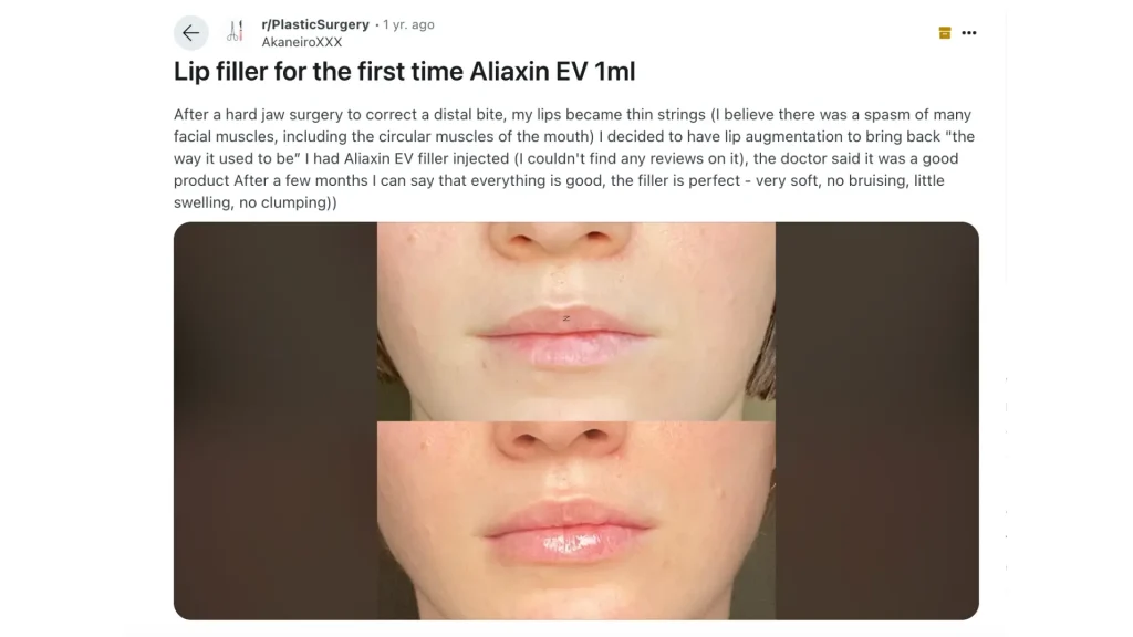 A patient's before and after photo of their Aliaxin EV filler for lips.