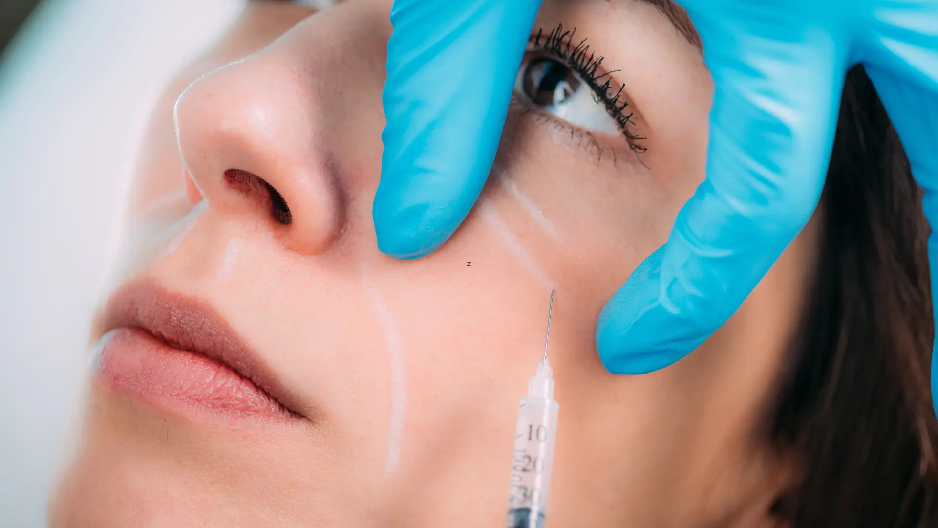 A patient receiving a dermal filler injection for their cheek region.