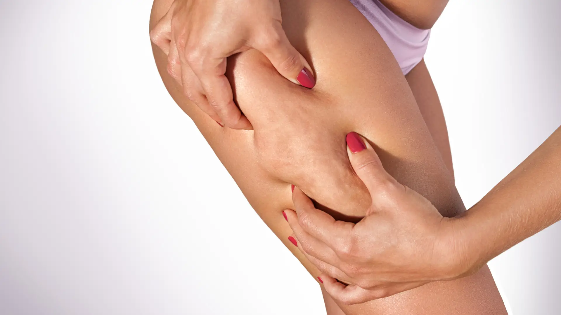 An individual showing off cellulites in their thigh region.
