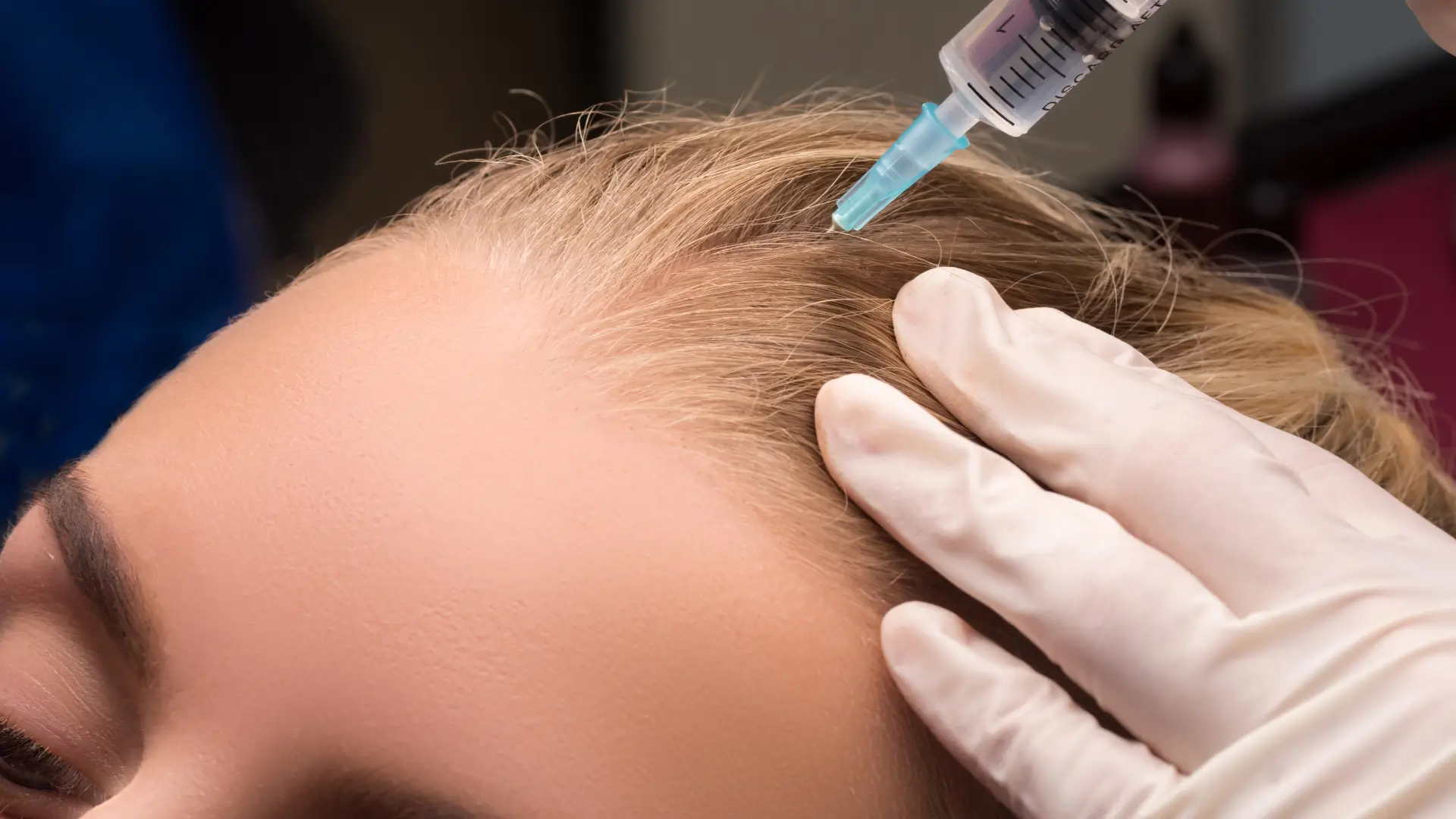 An individual undergoing a hair mesotherapy treatment.