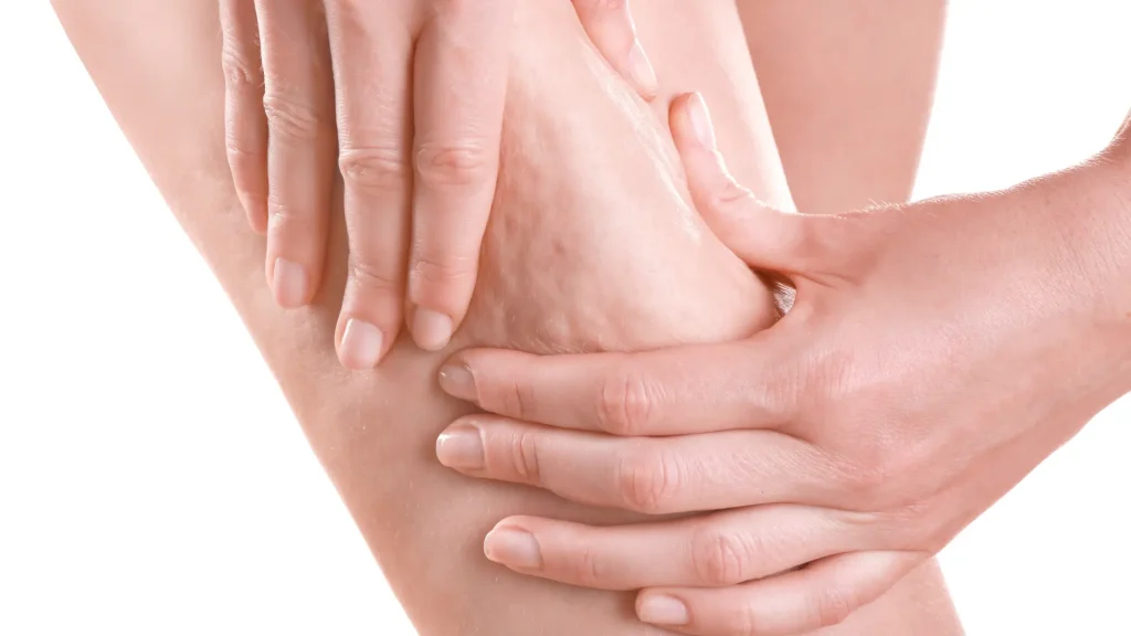 An individual dealing with cellulite on their thigh region.