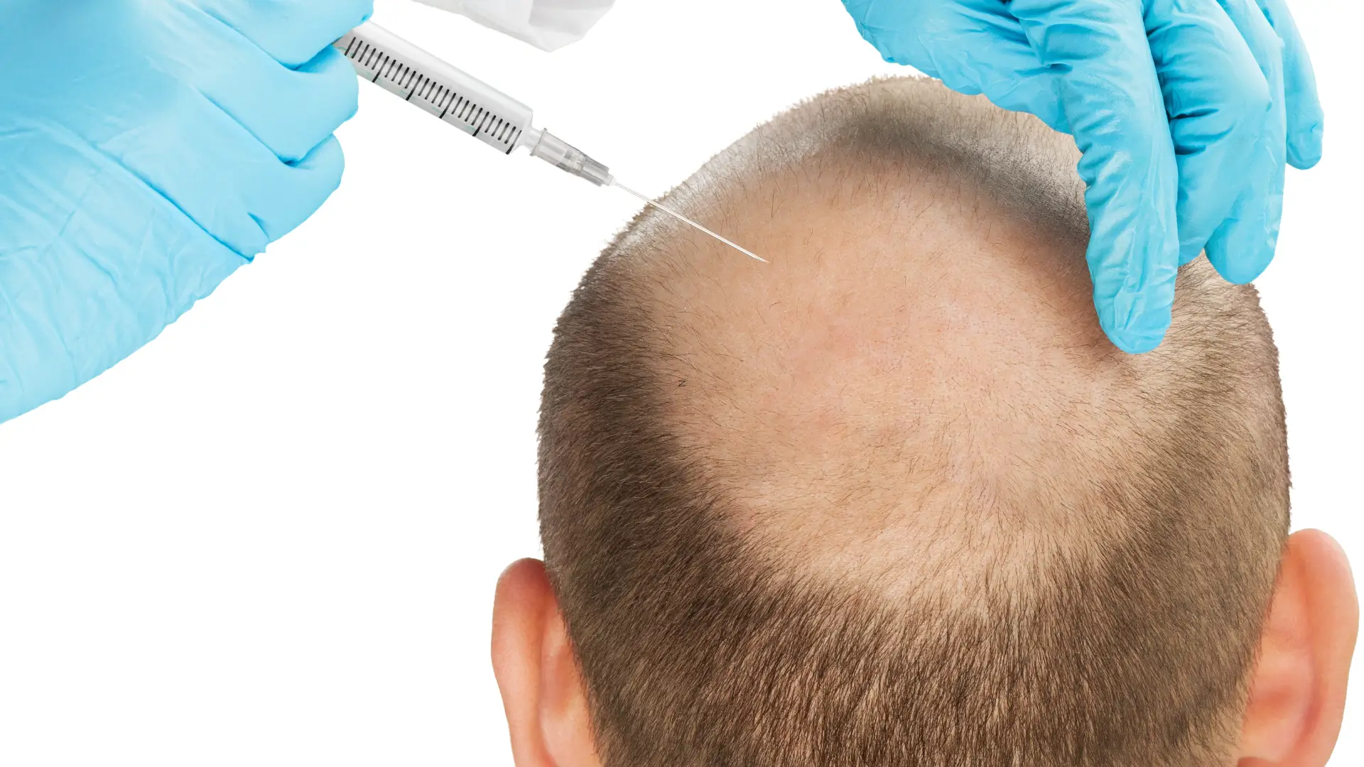 A patient receiving an injection for their hair loss or baldness.