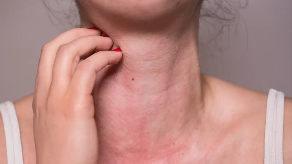 An individual suffering from severe itching as a symptom of an allergic reaction.