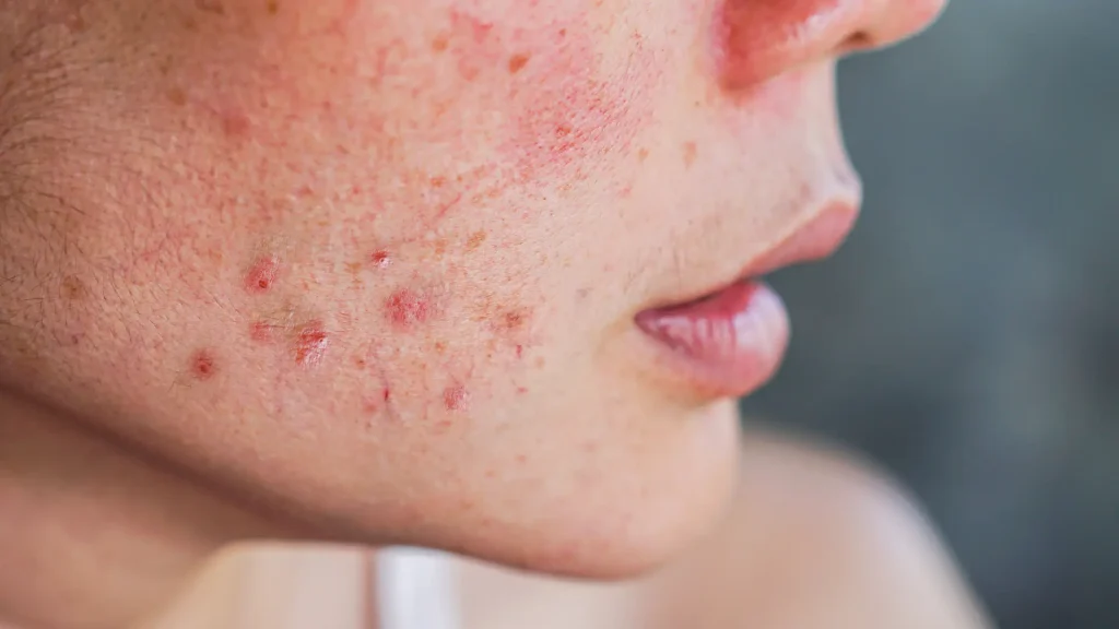 An individual suffering from rash and redness in their facial area.