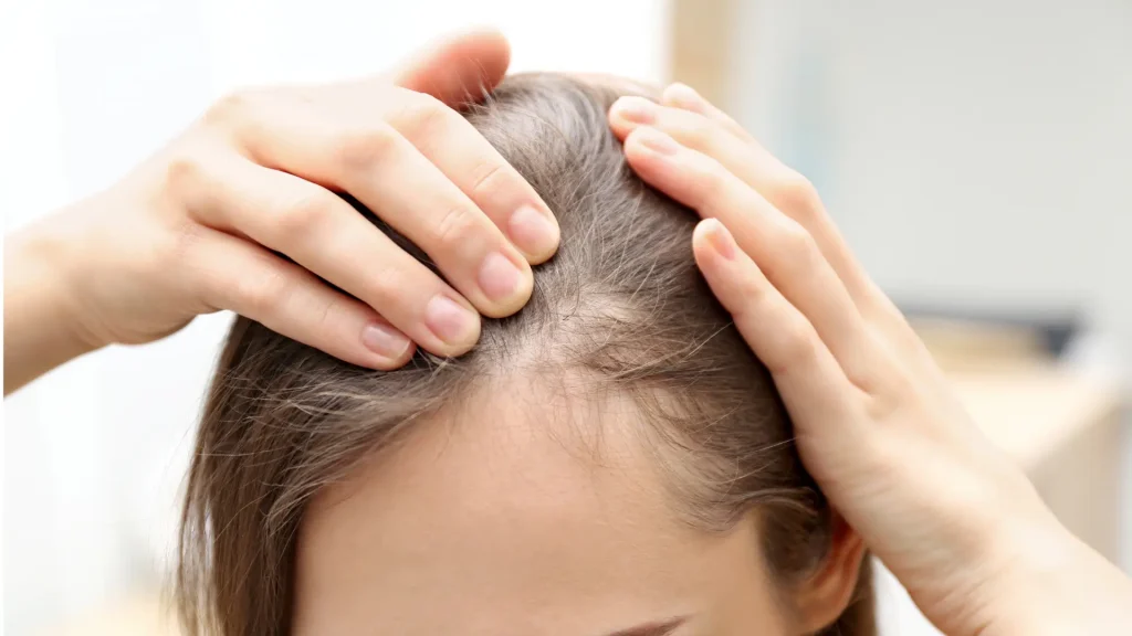 An individual dealing with hair loss.