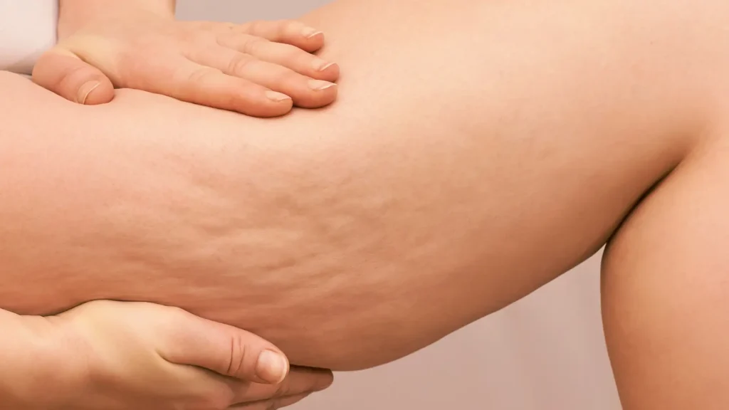 An individual showing cellulite in their thigh.