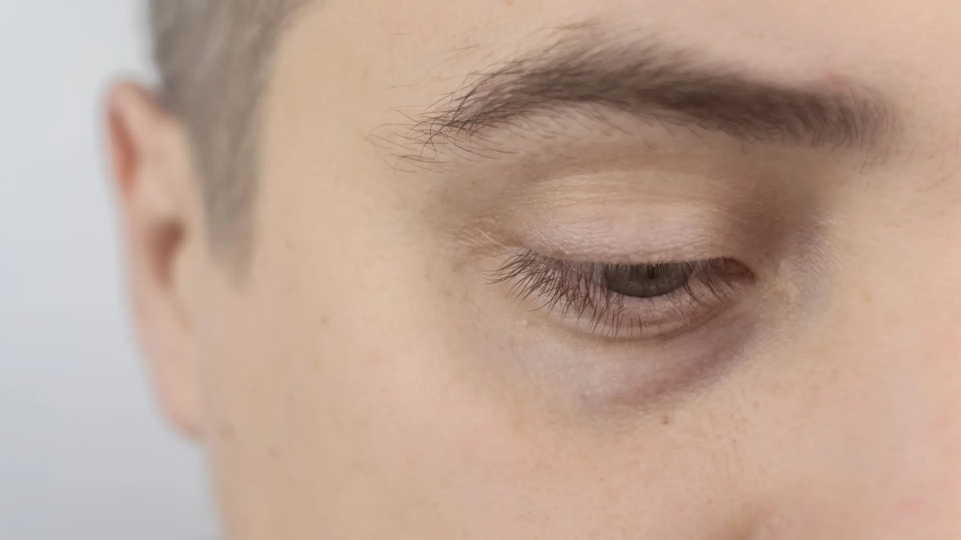 An individual dealing with dark circles and bags under the eyes.