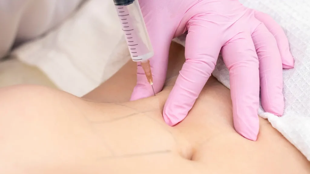A medical professional adminstering an injection into their abdomen region for cellulite.