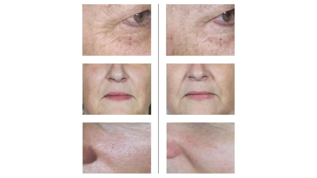 A patient's before and after photos of their NCTF 135 HA treatment for various facial wrinkles.