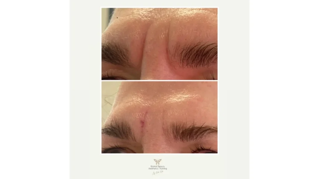 A patient's before and after photo of their '11' lines treatment with M HA 10.