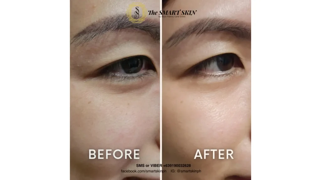 A patient's before and after photo of their eye and under eye treatment with NCTF 135 HA.