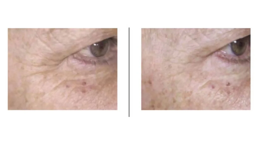 A patient's before and after photos of their eye region treatment with NCTF 135 HA.