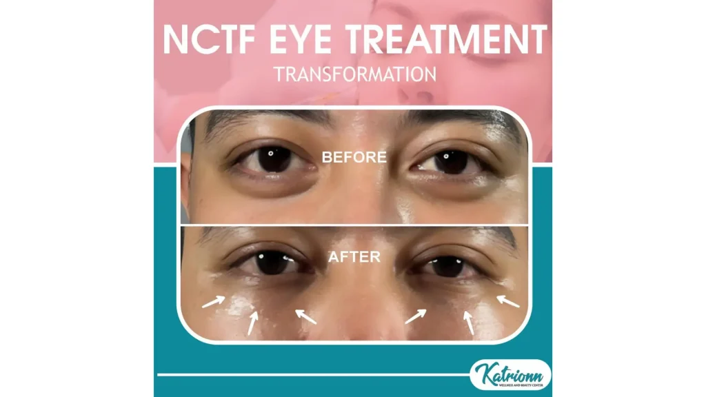 A patient's before and after photos of their NCTF 135 HA treatment for their under eyes.