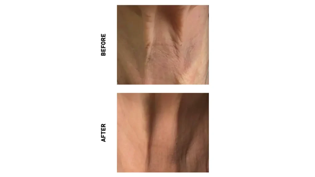 A patient's before and after photo of their neck region with M HA 10 treatment.