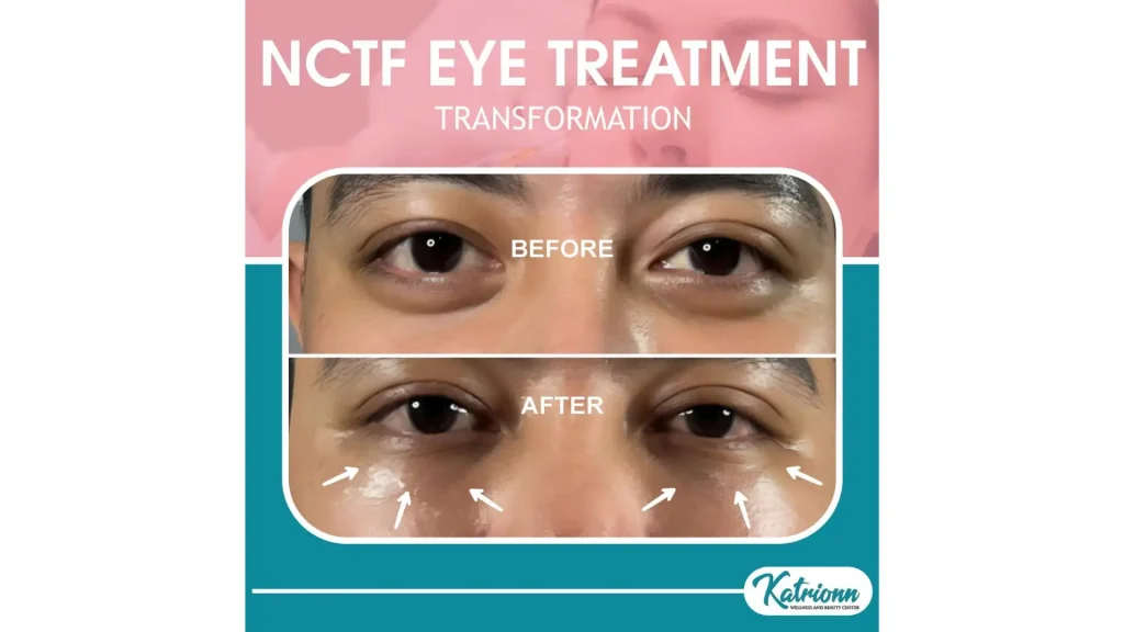 A patient's before and after photo of their under eye treatment.