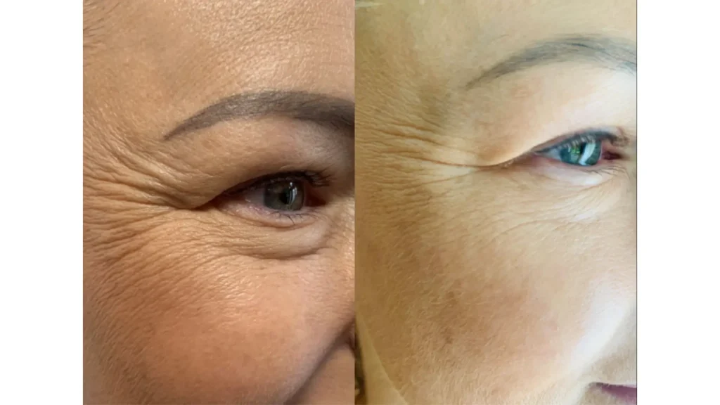 A patient's before and after photo of their treatment with Juvelook skinbooster.