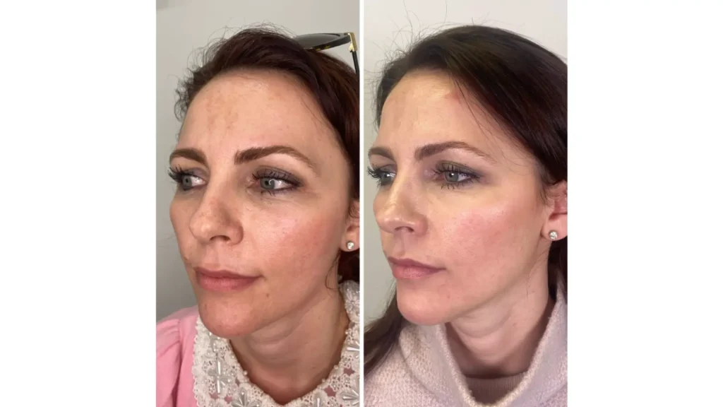 A patient's before and after photo of their Profhilo injection treatment.