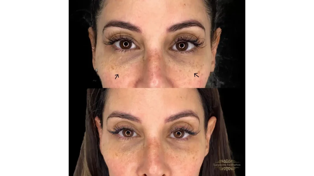 A patient's before and after photo of their under-eye to midfce regions.