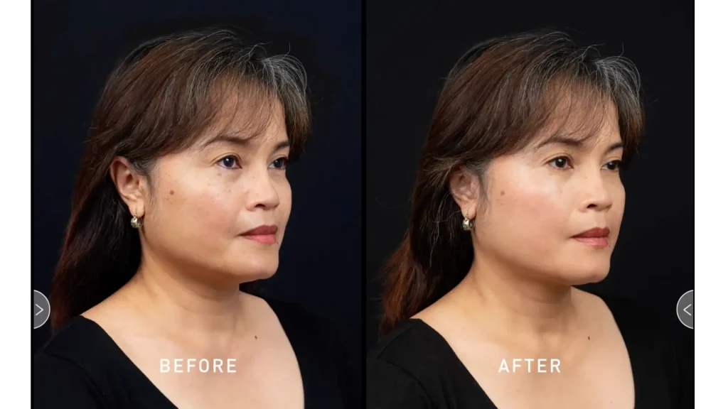 A patient's before and after photos of their NCTF 135 HA treatment.