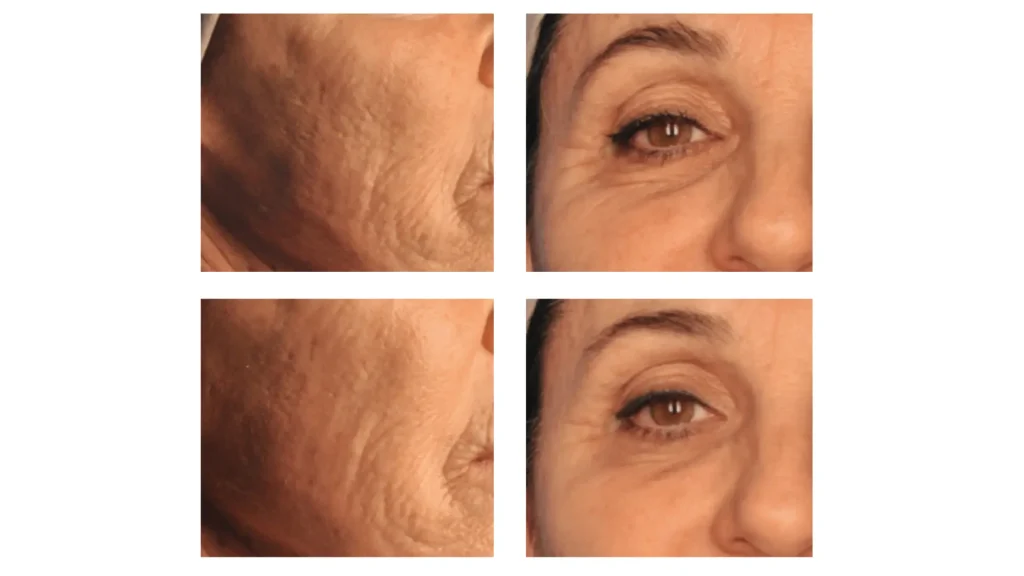 A patient's before and after photo of their cheek and under eye treatment with M HA 10 skin booster.