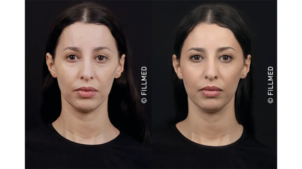 A patient's before and after photo of their facial enhancement with NCTF 135 HA.
