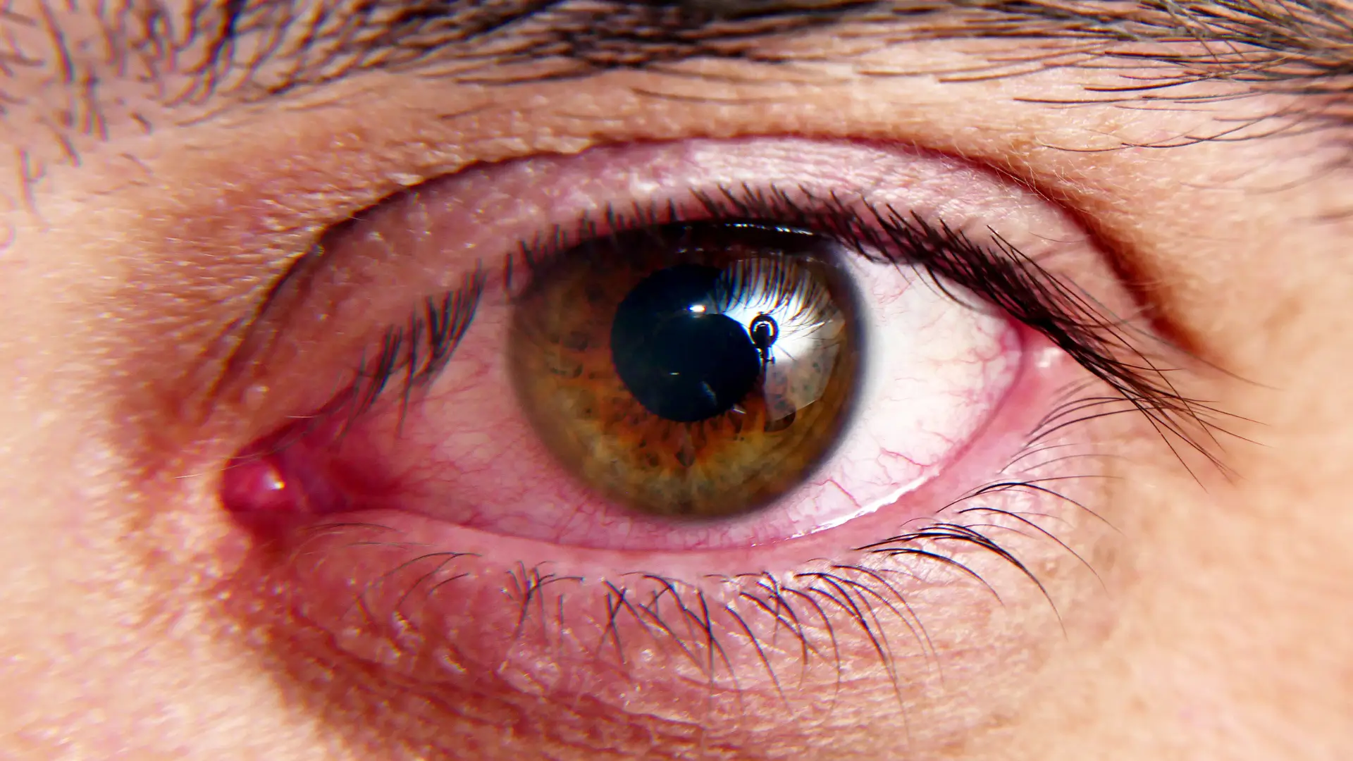 An individual suffering from eye redness.
