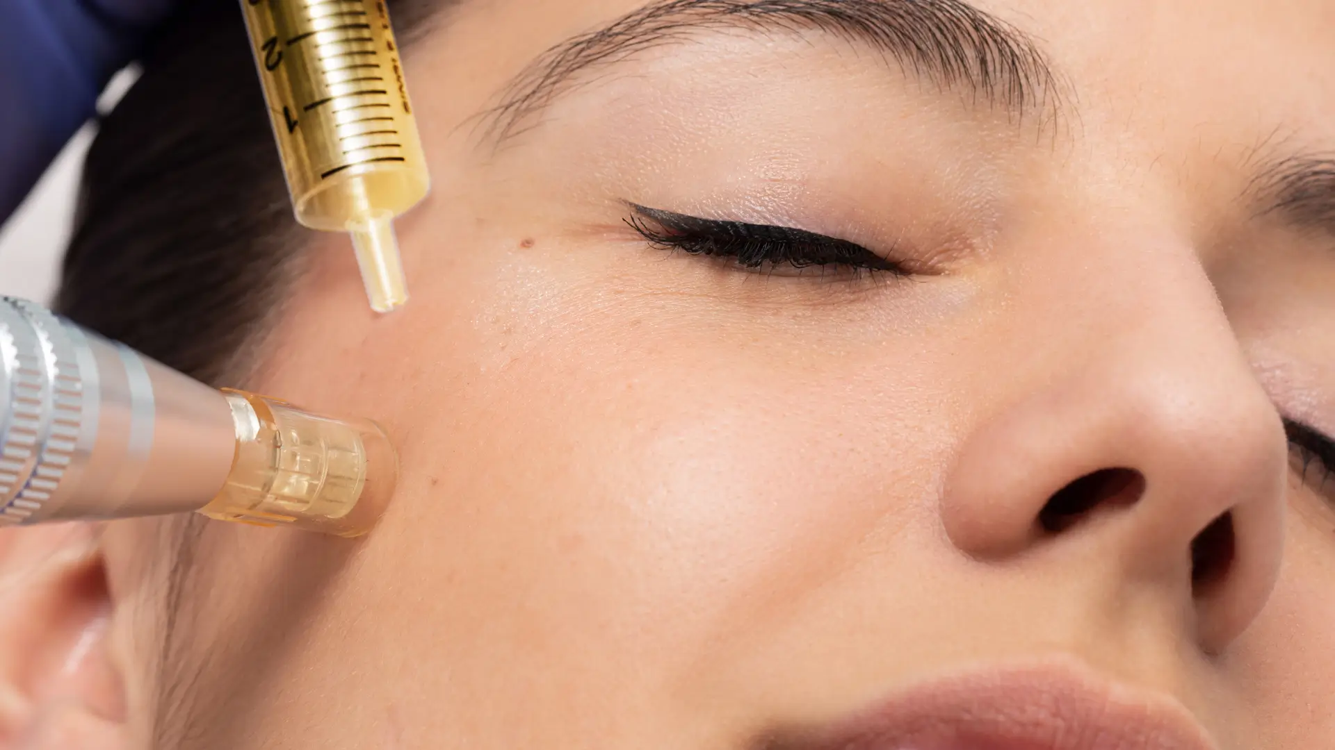 An individual undergoing a microinjection session on their facial region.