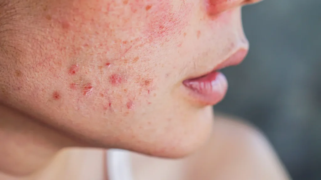 An individual dealing with redness, rash, bumps, and acne on their facial skin.