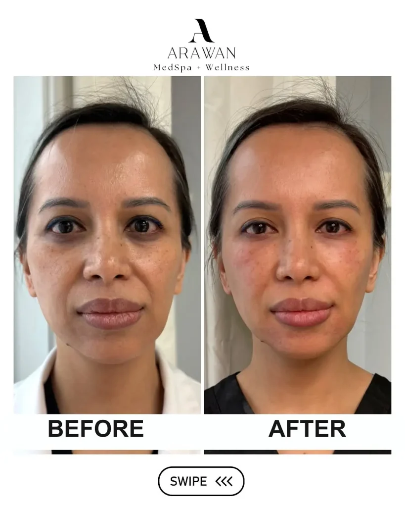 A patient's before and after photo of their PRP facial treatment.